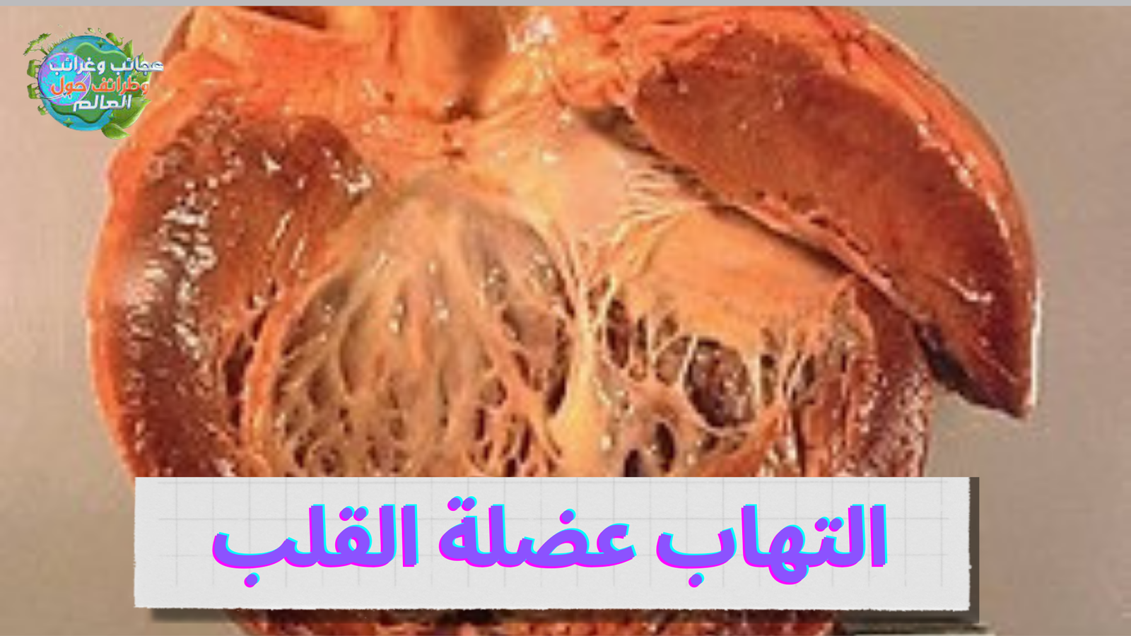 التهاب عضلة القلب,عضلة القلب,التهاب الحلق,تشخيص التهاب عضلة القلب والتهاب التامور,اعتلال عضلة القلب,ضعف عضلة القلب,علاج ضعف عضلة القلب,التهاب عضلة القلب والتهاب التامور,علاج عضلة القلب,اسباب ضعف عضلة القلب,أسباب التهاب عضلة القلب,اسباب التهاب عضلة القلب,معالجة التهاب عضلة القلب,التهابات عضلة القلب,لقاح فايزر والتهاب عضلة القلب,التهاب عضلة القلب مع تطعيم كورونا,التهاب العضلة القلبية,التهاب عصلة القلب,التهاب في عضله القلب,التهاب في القلب,القلب
