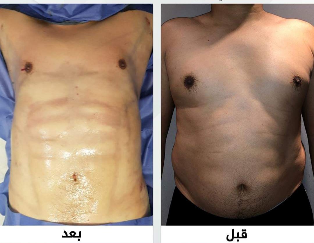 شفط دهون البطن