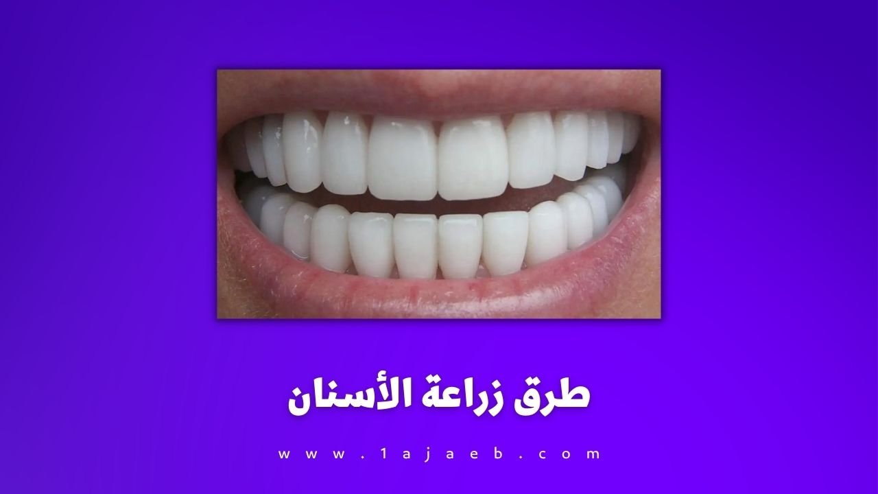 طرق زراعة الأسنان: أهم المعلومات